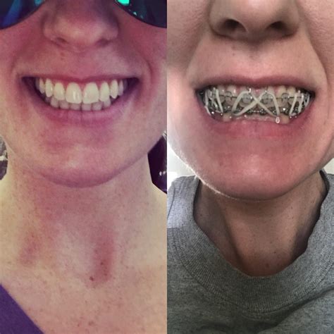 Both Pics Taken This Morning Before And After My Braces Were Removed After 5 Years And Jaw