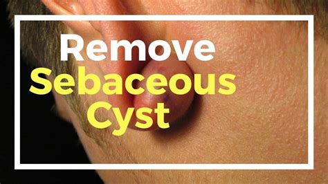18 Remedies To Remove Sebaceous Cyst Naturally At Home Cysts