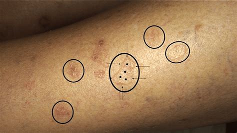 Cureus Disseminated Superficial Actinic Porokeratosis Dsap A Case