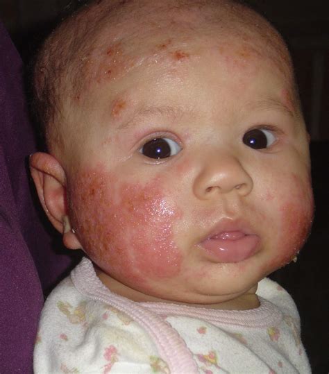Baby Face Eczema Pictures Dorothee Padraig South West