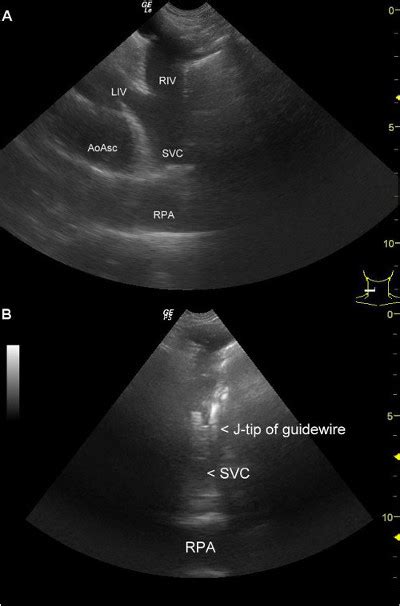 The Supraclavicular Fossa Ultrasound View For Central Venous Catheter