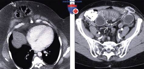 Вентральная грыжа диета Лучевая диагностика вентральной грыжи Лучевая диагностика вентральной грыжи Вентральная грыжа диета