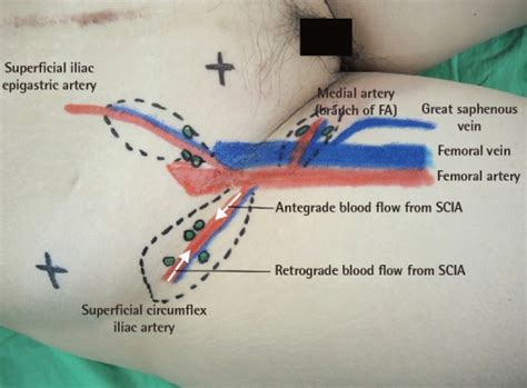 The most common causes of groin numbness are due to compression of the nerves, narrow spinal cord, infection affecting the nerves and spinal cord, or trauma from an injury. The anatomical landmark shows options in the groin area ...