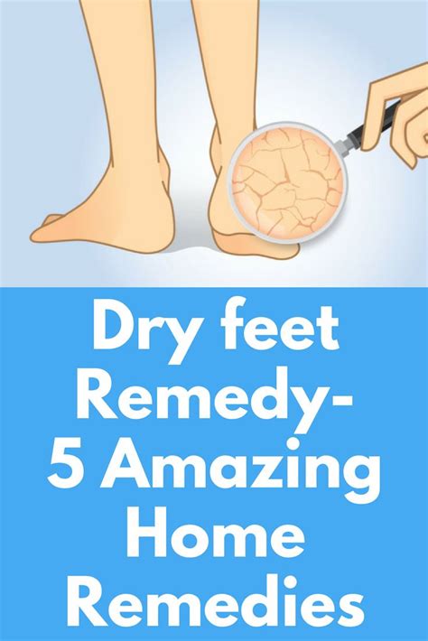 Dry Feet Remedy 5 Amazing Home Remedies So You Went To Try On A Pair