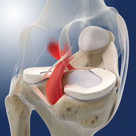 Posterior Cruciate Ligament Tears And Treatment