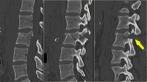 The Radiology Assistant Spine Thoracolumbar Injury