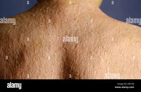 Male Back With Dry Itchy Scaly Skin Man Is Diseased By Psoriasis