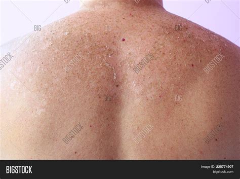 Traces Of Sunburn On The Back Of A Man The Consequence Of Excessive Sunburn Image Stock Photo