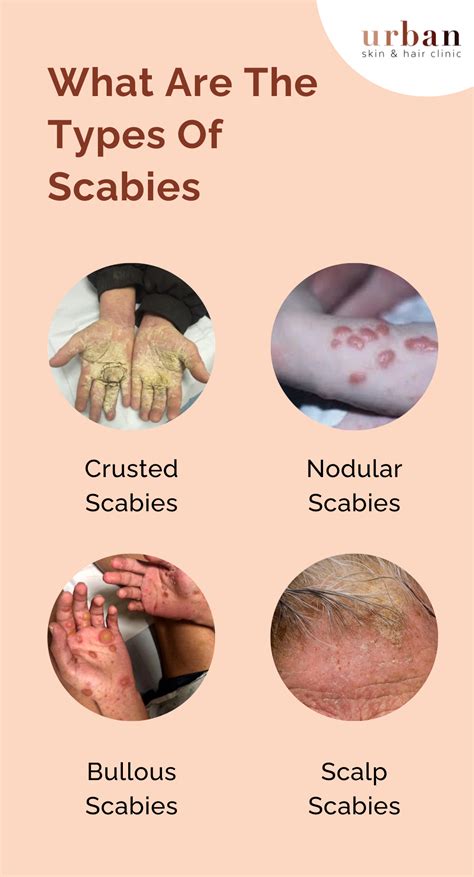 Scabies Types Causes Symptoms And Treatment Ushc