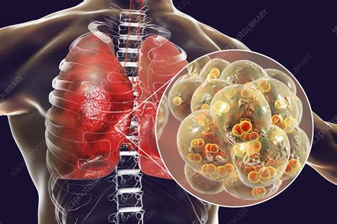 Pneumococcal Pneumonia Illustration Stock Image F0226828
