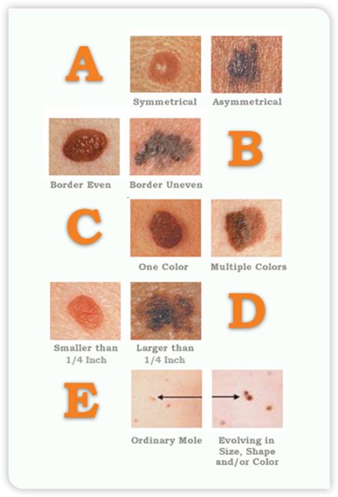 All five stages of melanoma—explained by a dermatologist. Melanoma Symptoms, Stages & Metastatic Melanoma Symptoms