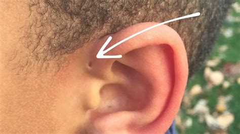 Preauricular Sinus Pit Or Cyst Causes Symptoms Diagnosis And Treatment