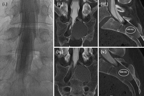 Microsurgical Fenestration Of Perineural Cysts To The Thecal Sac At The