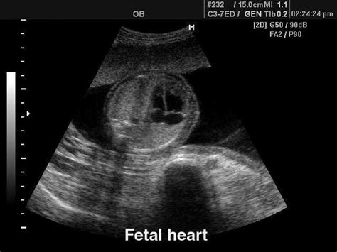 Ultrasound Images Fetal Heart B Mode Echogramm №122