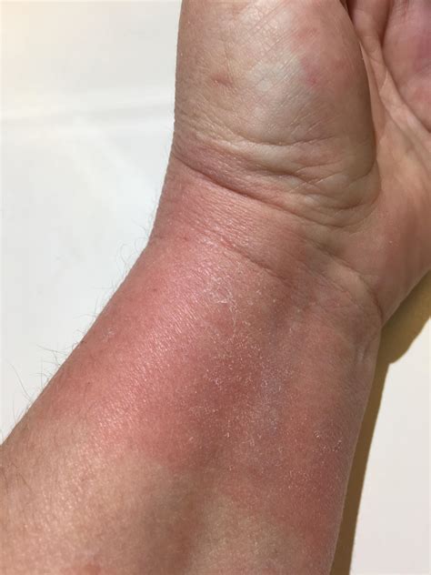 Arms Breaking Out In Itchy Bumps The Rash That Keeps Coming Back