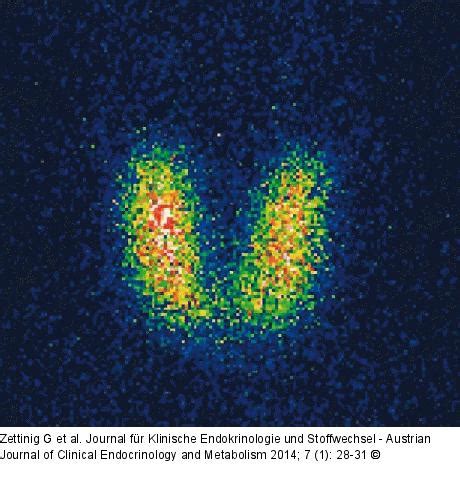 Hierunter versteht man die darstellung des organs mit einem schwach radioaktiven stoff, dem. Abbildung 8: Schilddrüse - Szintigraphie