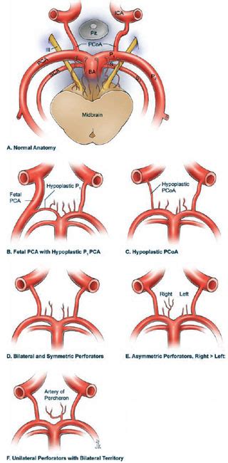 Basilar Artery Bifurcation Aneurysms Neupsy Key