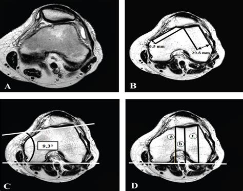 Mri Evaluation Of Trochlear Dysplasia As A Cause Of Patellar Instability