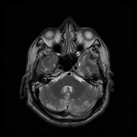 Bilateral Cerebellar Infarction Image