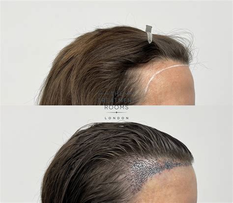 13 Best & Worst Female Hairstyles For A Receding Hairline - Wimpole