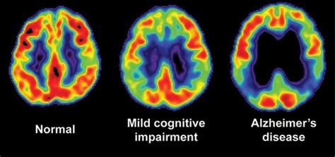 Memory Loss Reversed In 10 Alzheimers Patients Neuroscience News