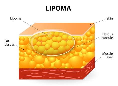 Understanding If Your Weight Loss Affects Lipoma Making Different