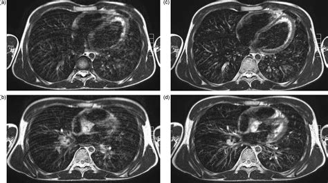 Mri Of The Lungs In Children European Journal Of Radiology