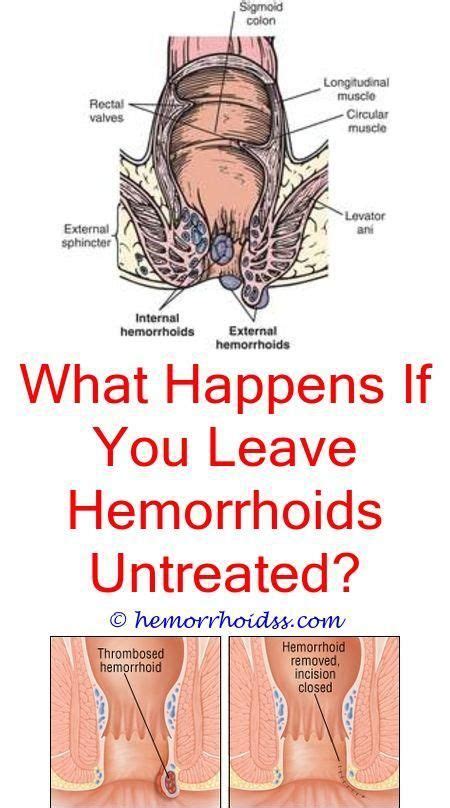 How To Get Hemorrhoids To Go Away Fastdoes Hemorrhoids Disqualify You