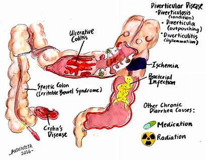 Colitis Disease Bowel Inflammatory Ulcerative Causes Mucus