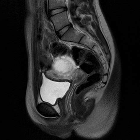 Hemorrhagic Ovarian Cyst Image Radiopaedia Org