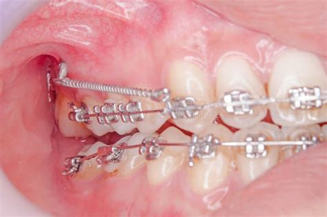 Orthodontics Procedure With Miniscrew Stock Image Image Of Check