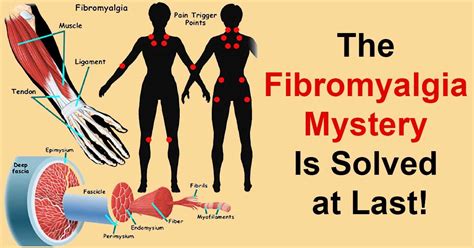 Fibromyalgia And Hives Fibromyalgia Rash Pictures And Treatment