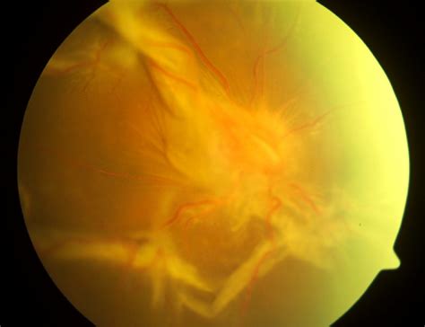 Retinal Detachment And Floaters Eagle Eye Centre