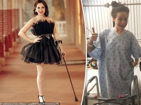 Cancer Patient 35 With Amputated Leg Launches Career As Pin Up Model