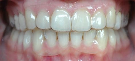 Zahn Und Kieferschmerz Nach Alignertherapie