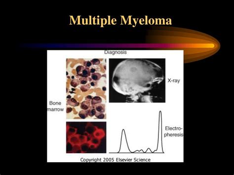 Ppt Multiple Myeloma Powerpoint Presentation Free Download Id563979
