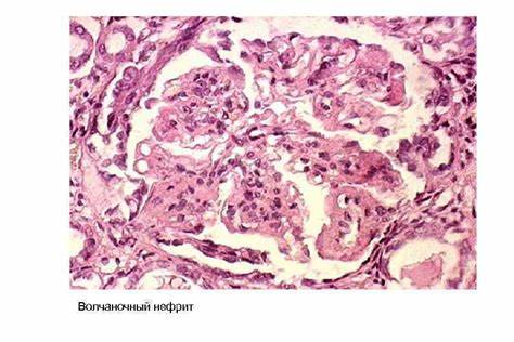 Волчаночный нефрит диета Лекция 8 Аутоиммунизация и аутоиммунные болезни Патогенез Синдромы Лекция 8 Аутоиммунизация и аутоиммунные болезни Патогенез Синдромы Волчаночный нефрит диета