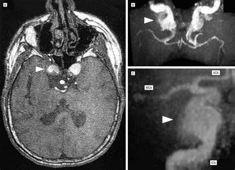 Cavernous Sinus Syndrome And Headache Due To Bilateral Carotid Artery