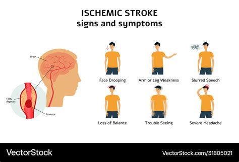 Ischemic Stroke Signs And Symptoms Infographic Vector Image