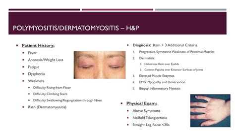 Ppt Dermatomyositis And Polymyositis Powerpoint Presentation Free Download Id