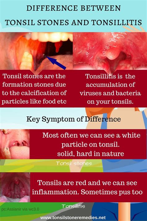 Differences Between Tonsil Stones And Tonsillitis The Diff Flickr