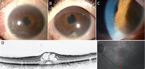 Bilateral Anterior Uveitis With Macular Edema In A Patient With Rpc