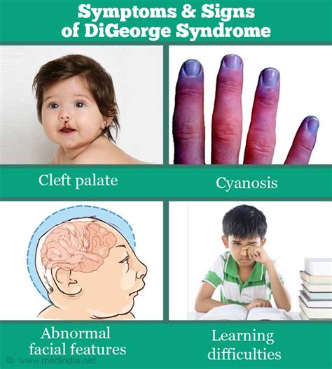 Digeorge Syndrome Causes Symptoms Diagnosis Treatment Prognosis
