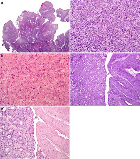 A Hpv Related Papillary Squamous Cell Carcinoma Of The Head And Neck