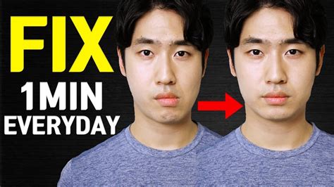 Fix Asymmetrical Face Tmj Dislocation Now Youtube