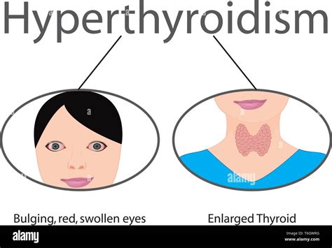 Hyperthyroidism Enlarged Thyroid Endocrine Disfunction Vector