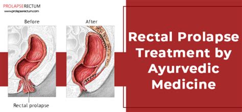 Rectal Prolapse Treatment By Ayurvedic Medicine