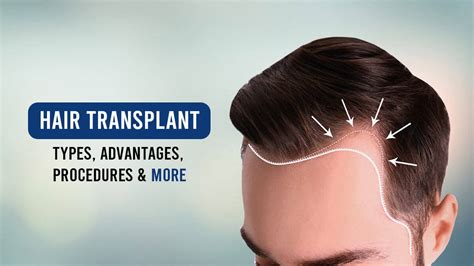 Details More Than Hair Transplant Images Best In Eteachers