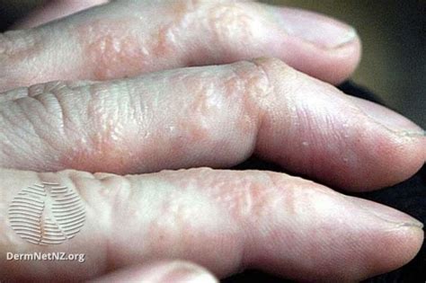 What Is Dyshidrotic Eczema Mother Makings