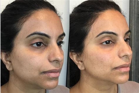 Dermal Fillers Before And After Pictures Case 111 Sacramento Ca